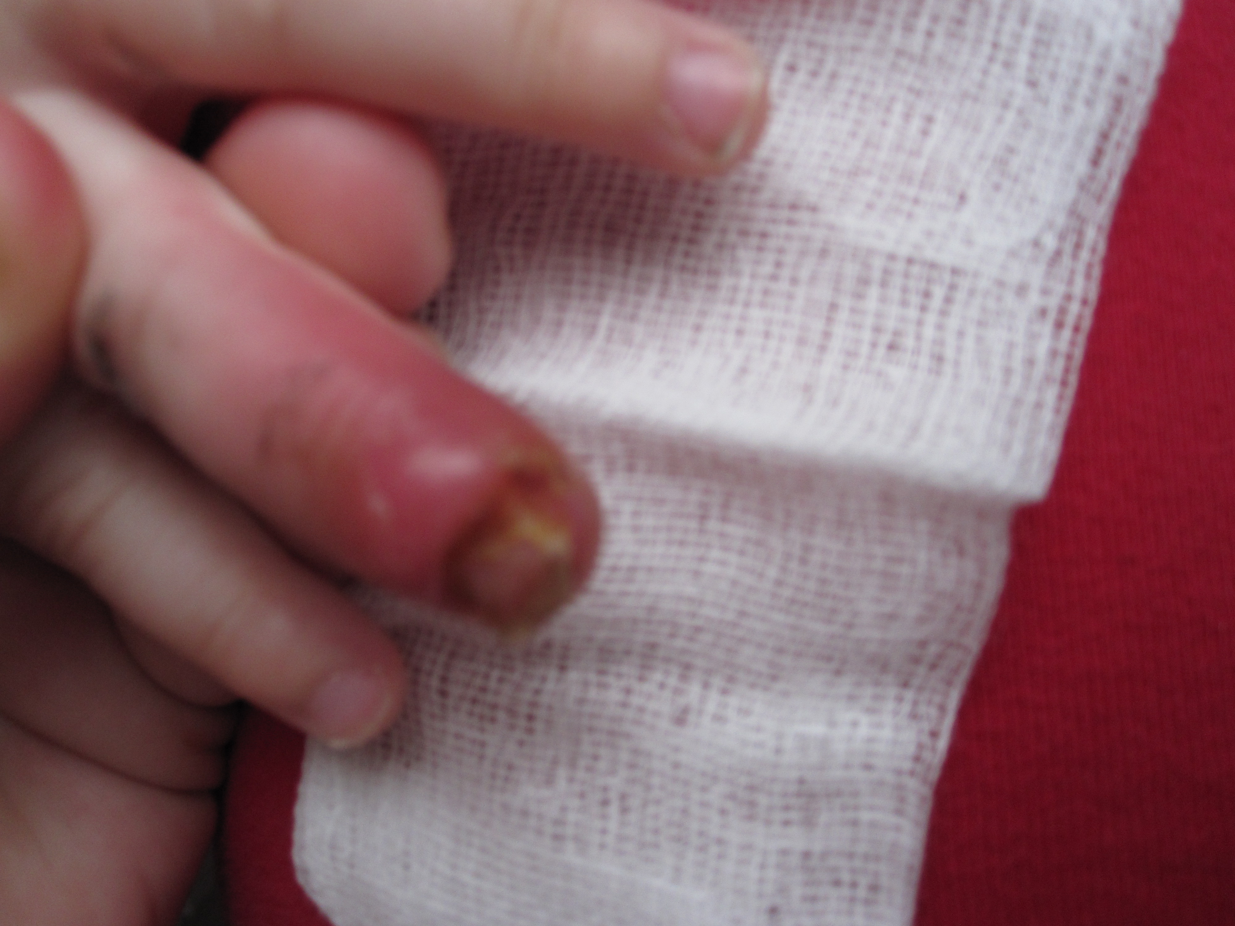Воспаление ногтевого ложа